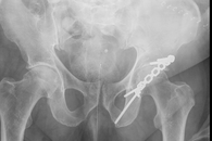 Traumatische Hüftluxation