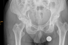 Fraktur des hinteren Beckenpfeilers