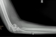 Ellenbogentrümmerfraktur