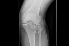 Impressionsfraktur des Schienbeinkopfes