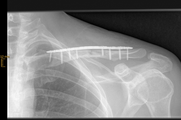 Schlüsselbeintrümmerbruch mit einer winkelstabilen Platte 