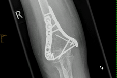 Ellenbogentrümmerfraktur mit Verplattung und Fragmentrefixation