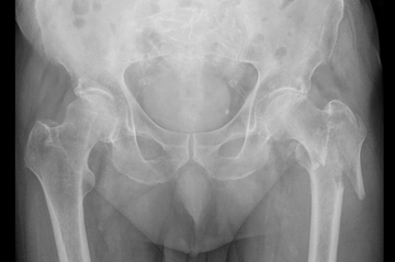 Pertrochantäre Hüftfraktur