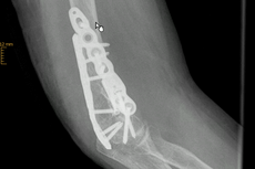Ellenbogentrümmerfraktur mit Verplattung und Fragmentrefixation
