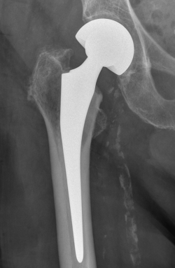 mediale Schenkelhalsfraktur mit einer Duokopf-Hüftendoprothese