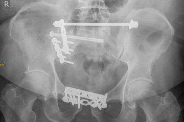 Beckenringfraktur mit Doppelplattenosteosynthese