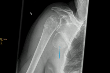 ältere dislozierte Humeruskopffraktur