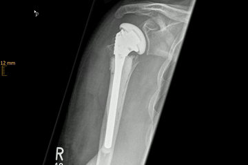 ältere dislozierte Humeruskopffraktur mit Schulterendprothese