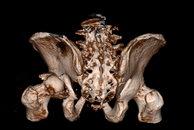 Traumatische Hüftluxation