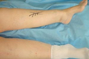 Farbige Seitenmarkierung Prävention einer Verwechslung