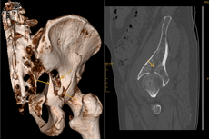Fraktur des hinteren Beckenpfeilers