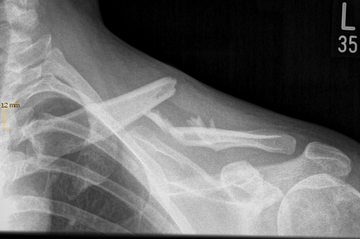 Schlüsselbeintrümmerbruch