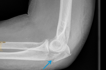 Olekranonfraktur mit Osteosynthese 