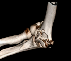 Ellenbogentrümmerfraktur