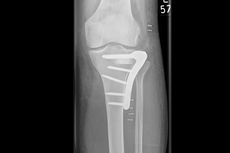 Impressions-Fraktur des Schienbeinkopfes