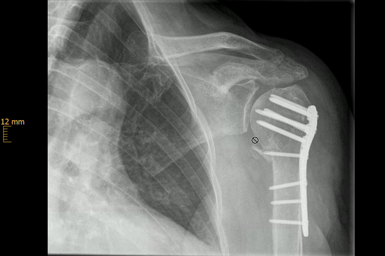 dislozierter Humeruskopffraktur mit Plattenosteosynthese