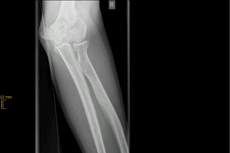 Ellenbogentrümmerfraktur