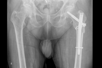 Pertrochantäre Hüftfraktur