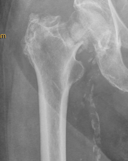 mediale Schenkelhalsfraktur nach Sturz 