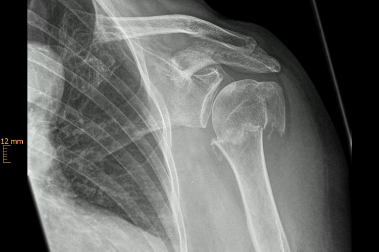 dislozierte Humeruskopffraktur