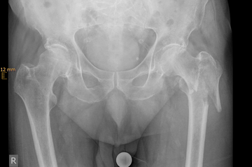 Pertrochantäre Fraktur