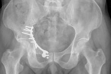 Fraktur des hinteren Beckenpfeilers mit Osteosynthese